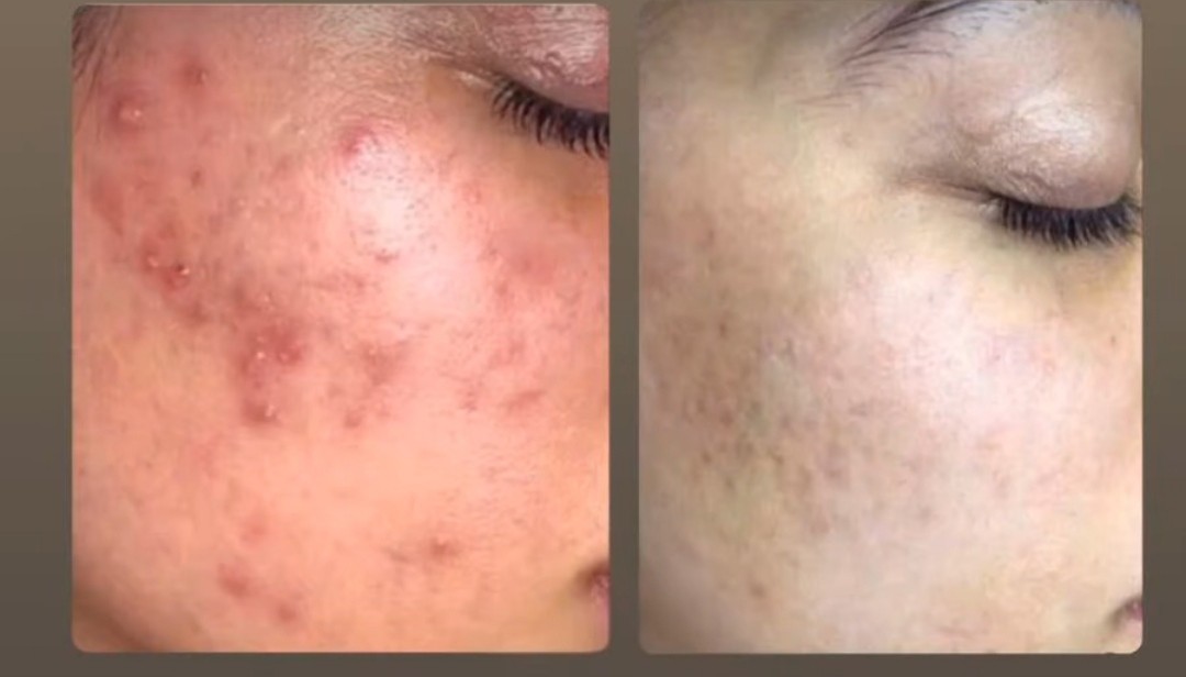 Allure #sarajevo Tretman lica Aquatherm - tretman za osetljivu kožu