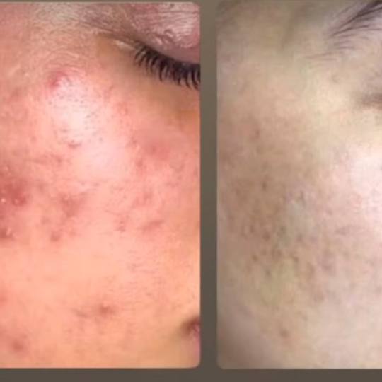 Allure #sarajevo Tretman lica Aquatherm - tretman za osetljivu kožu