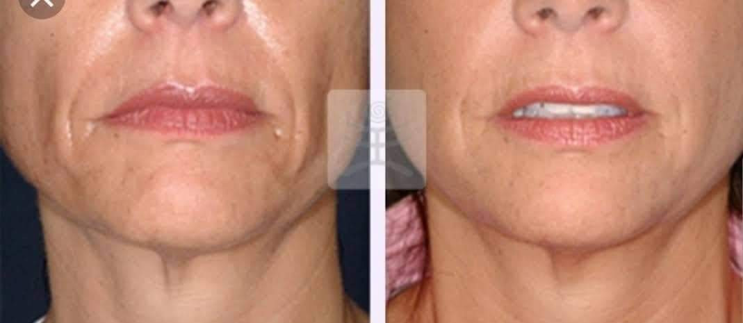 Sandra #visoko Tretman lica Lipoliza - podbradak