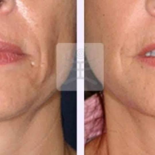 Sandra #visoko Tretman lica Lipoliza - podbradak Šta je lipoliza i kako uklanja celulit?

Sam poj