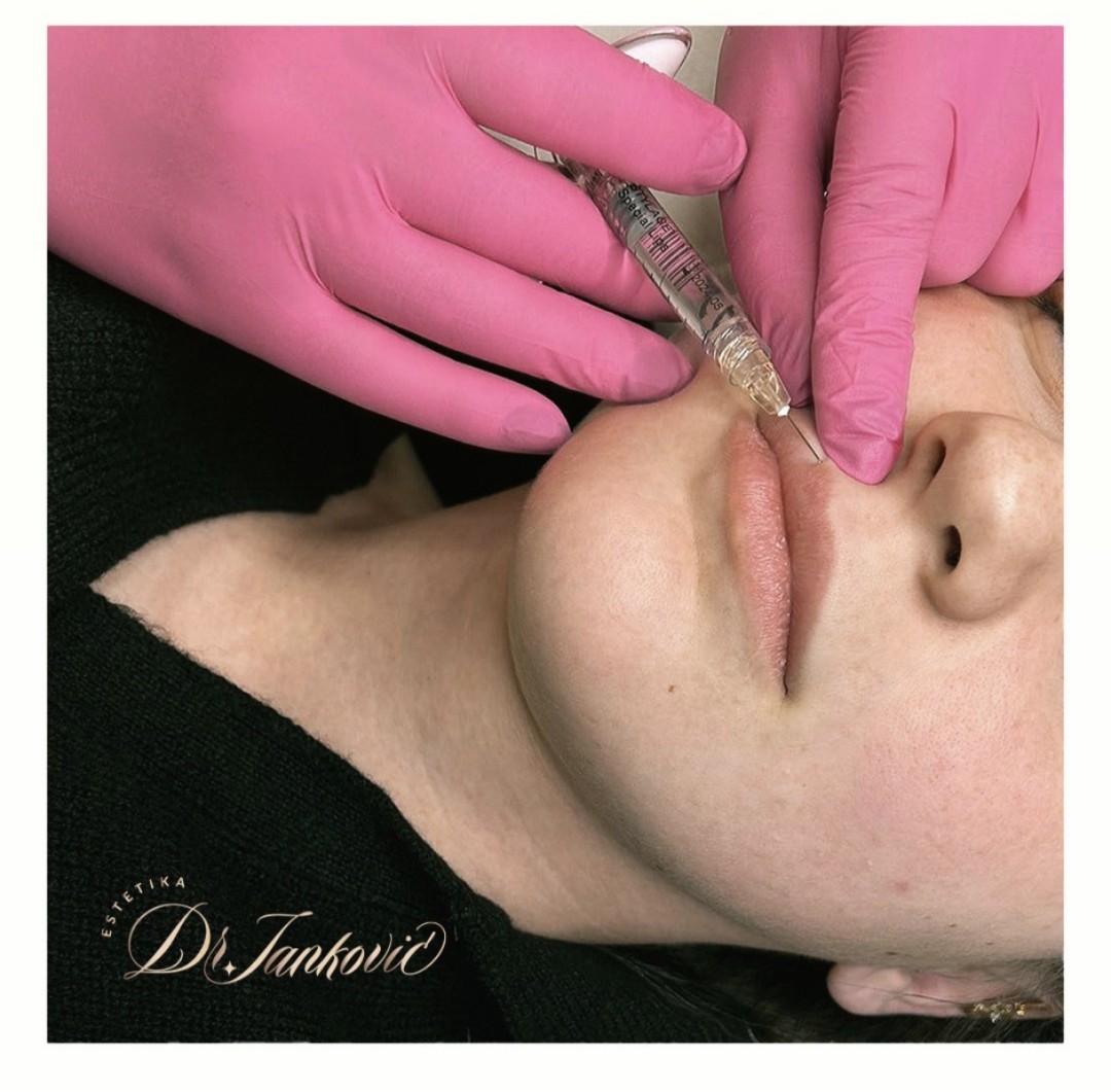 Estetika Janković #banjaluka Tretman lica Hijaluronski filer - 1 ml