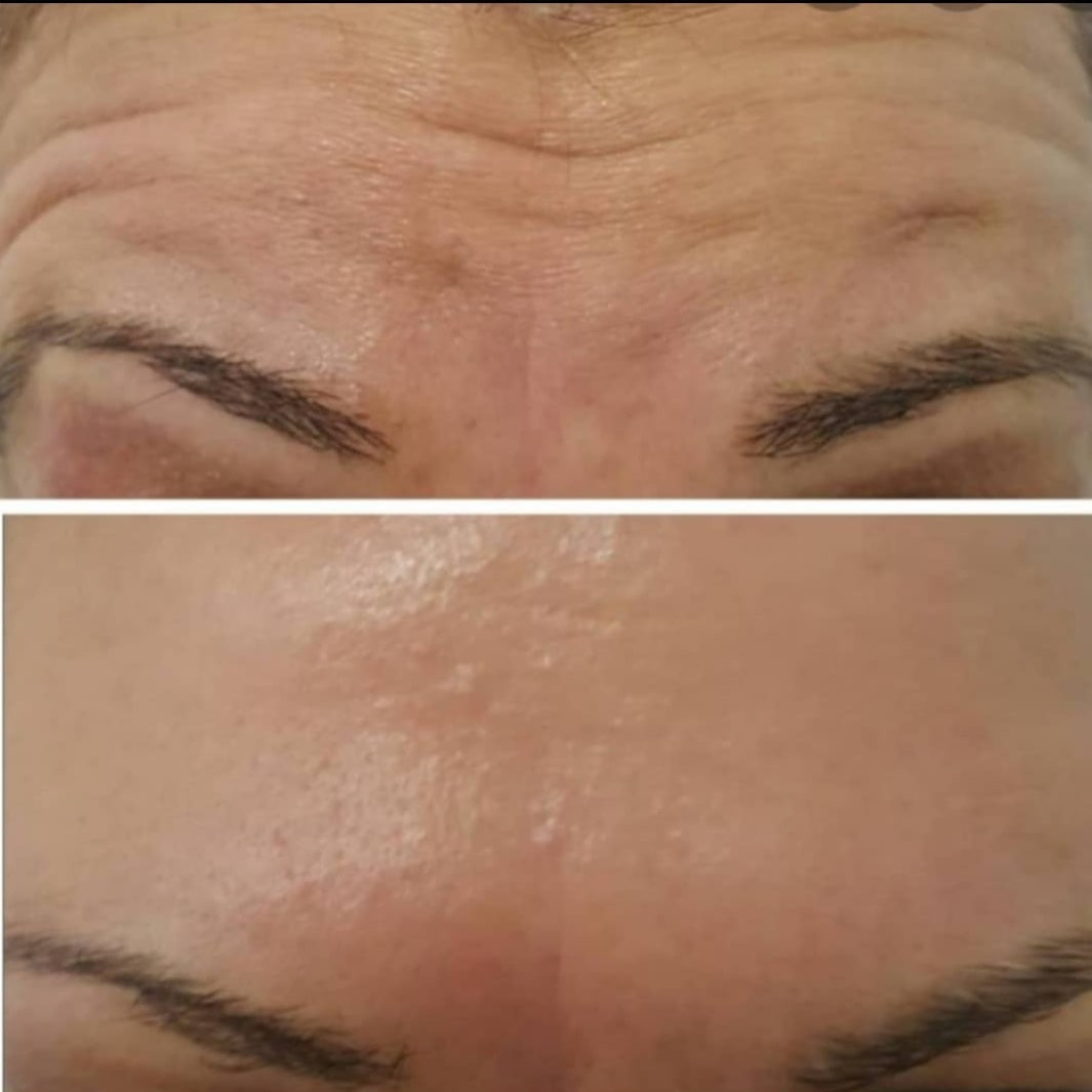 Sandra #visoko Tretman lica HIFU - cijelo lice