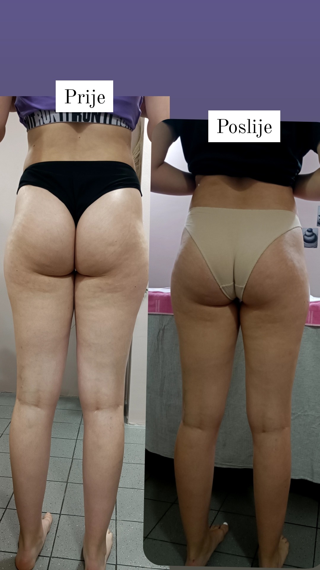 Ayana Spa #sarajevo Anticelulit masaža Maderoterapija nogu i stražnjice