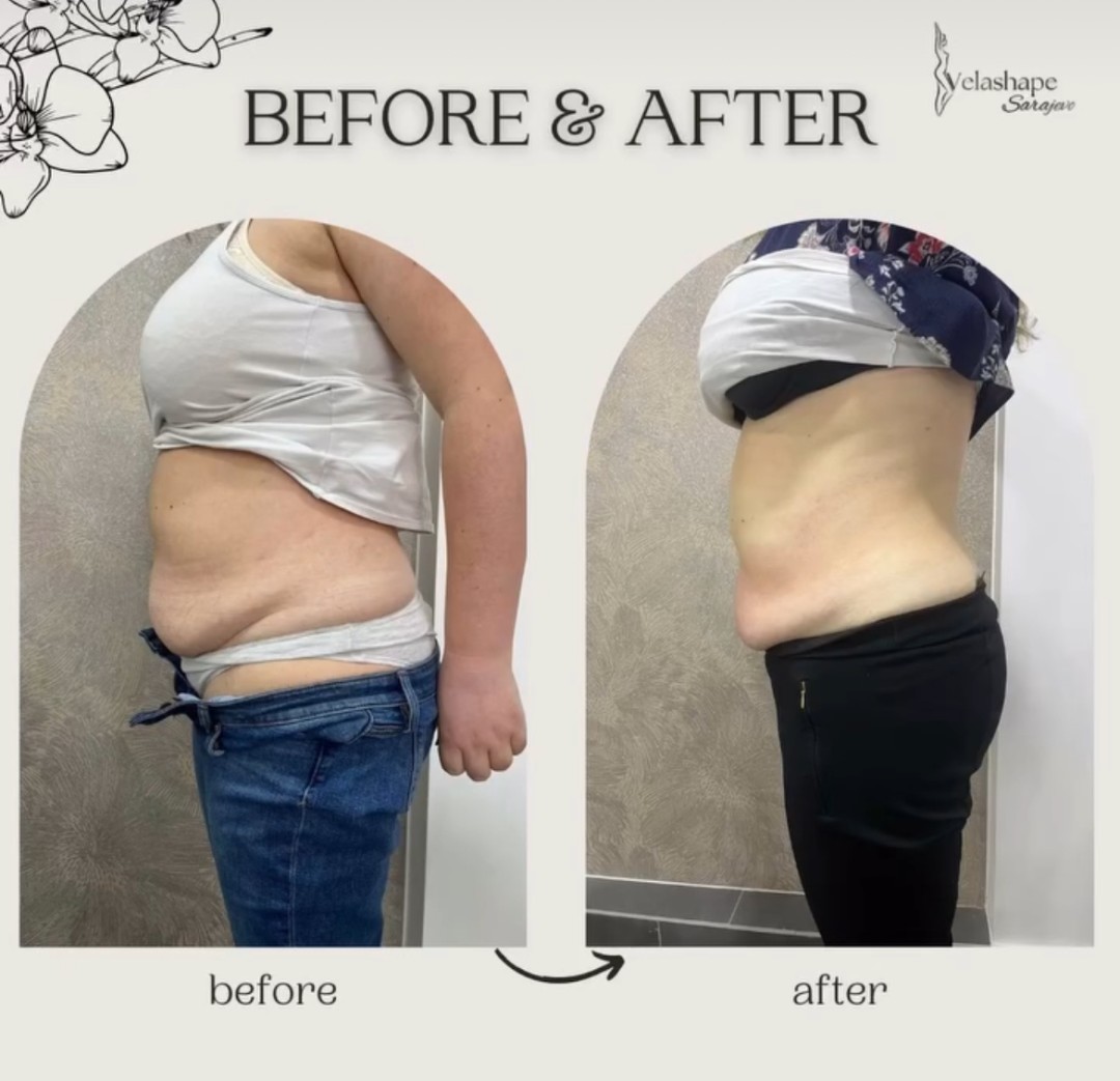 VelaShape #sarajevo Air brush potamnjivanje kože Velashape + RF tretman - stomak
