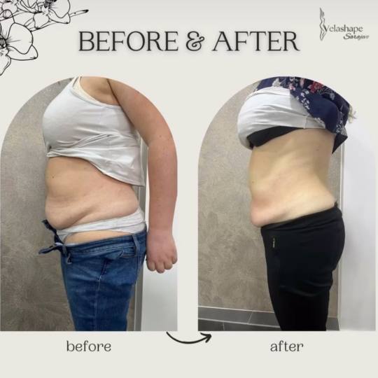 VelaShape usluga
