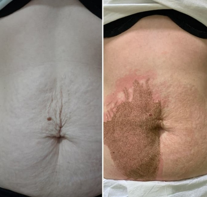 Plazma pen - celog lica - Poezija ljepote, Sarajevo Tretman lica Lice Tretman lica, Sarajevo, Novo Sarajevo - Novi Grad