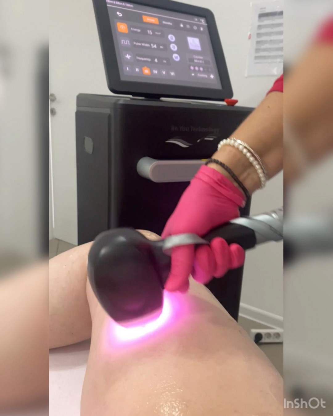 Laser Beauty Studio #visoko Laserska epilacija Laserska epilacija cijelih nogu - za dame