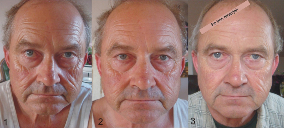 Vedrana #sarajevo Tretman lica