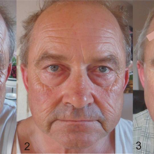 Vedrana #sarajevo Tretman lica Japanski Cosmo Lifting SORENSENSISTEM™


Japanski Cosmo Lifting 