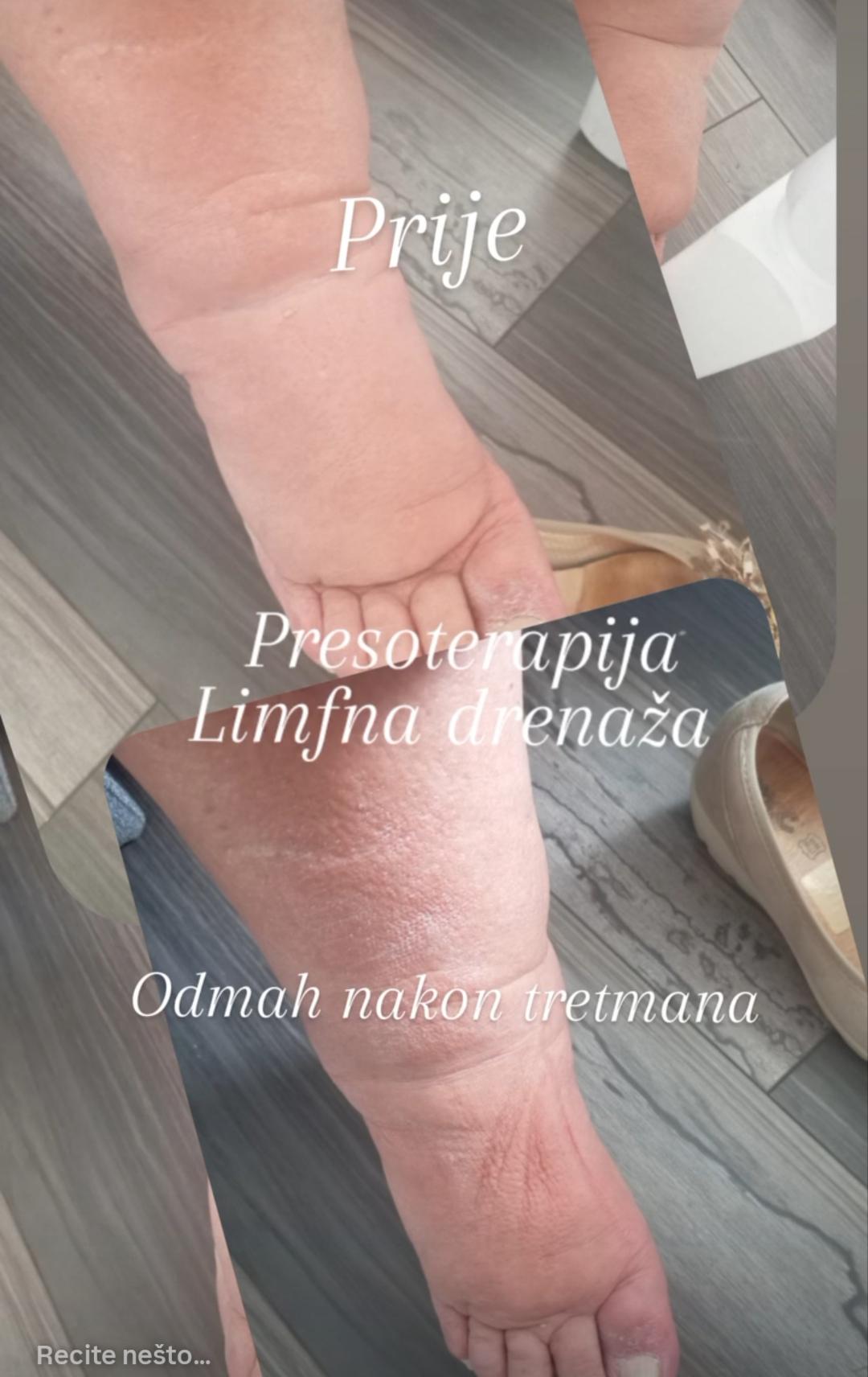 Limfna drenaža - 30 minuta - Medina Studio, Sarajevo Tretmani tijela Tijelo Tretmani tijela, Sarajevo, Novo Sarajevo - Novi Grad