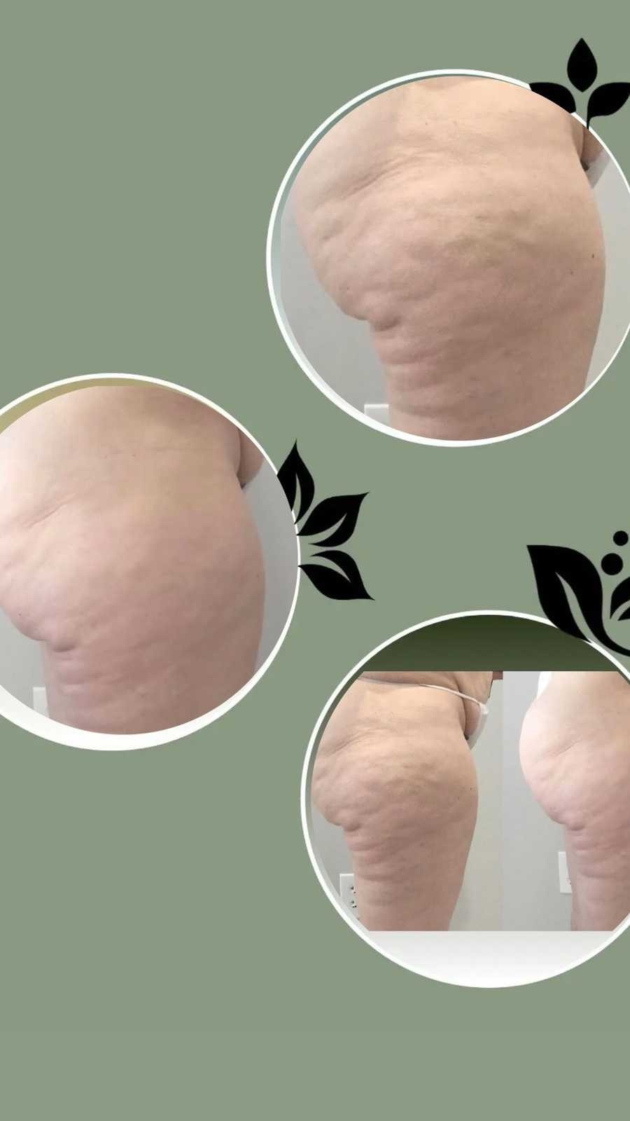 Signature #tuzla Tretmani tijela Endosfera