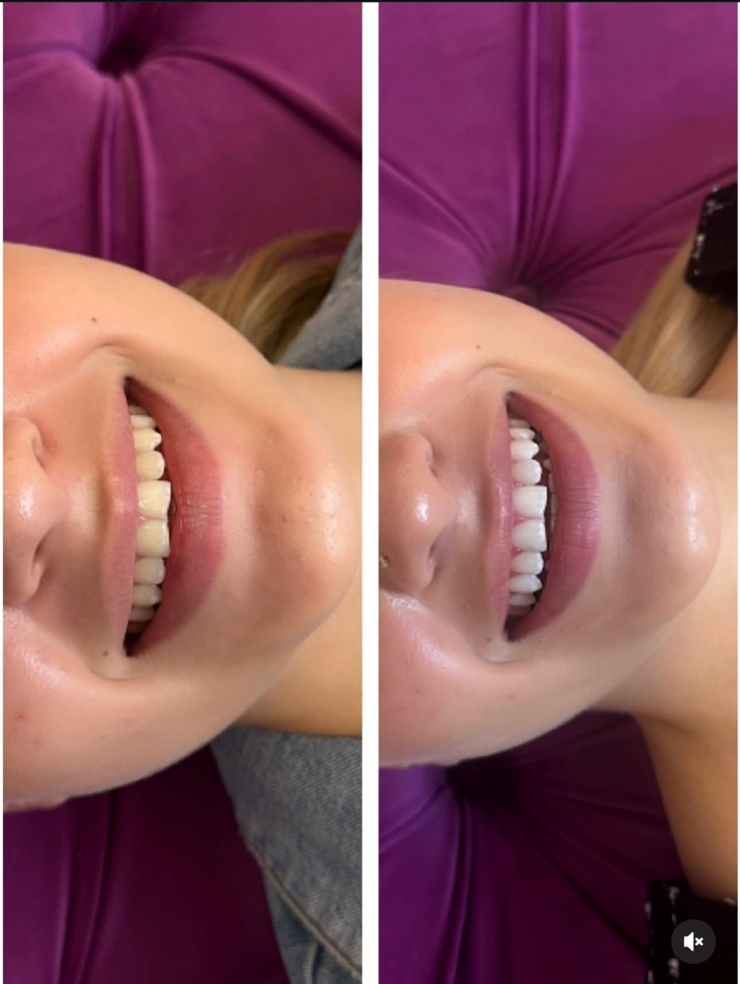 Izbjeljivanje zuba - Perfect Smile, izbjeljivanje zuba Cazin, Cazin Zubi Wellness Zubi, Cazin, Centar