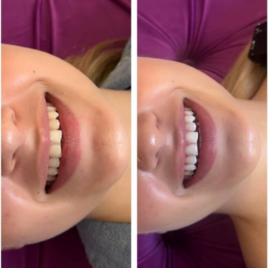 Perfect Smile, izbjeljivanje zuba Cazin usluga