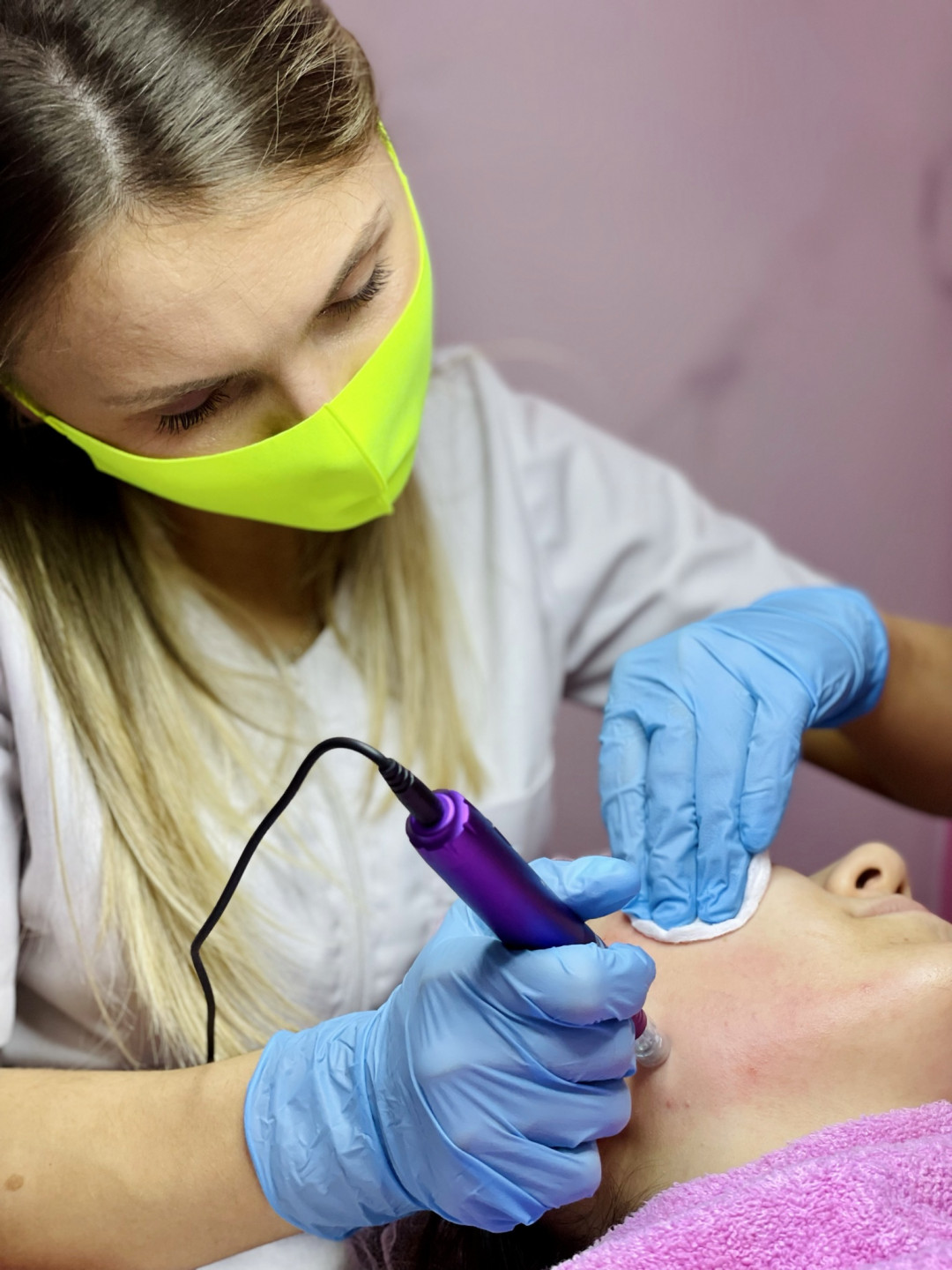 AEsthetic Bar Academy #sarajevo Tretman lica Microneedling - protiv akni i ožiljaka