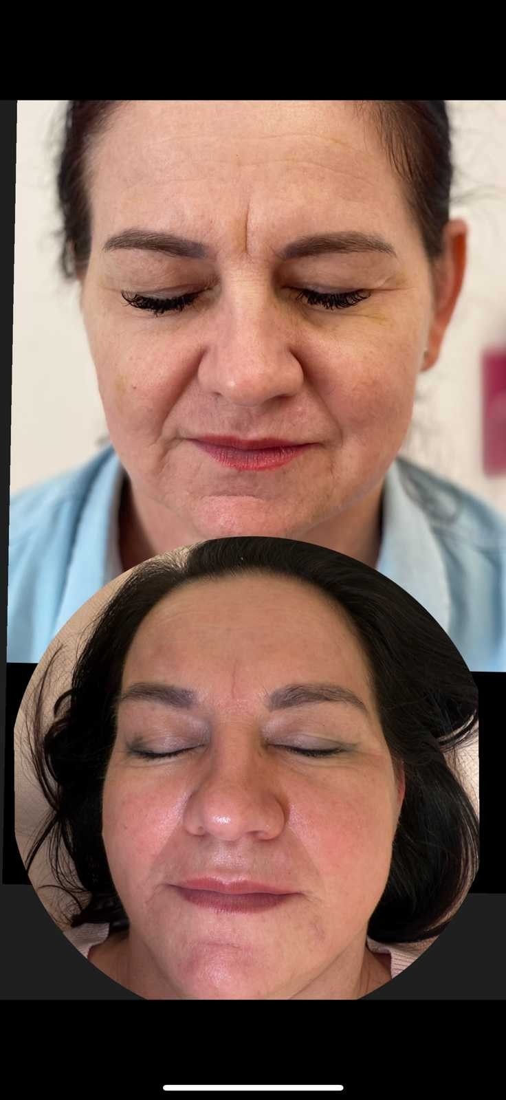 Signature #tuzla Lifting / zatezanje kože Egzosomi