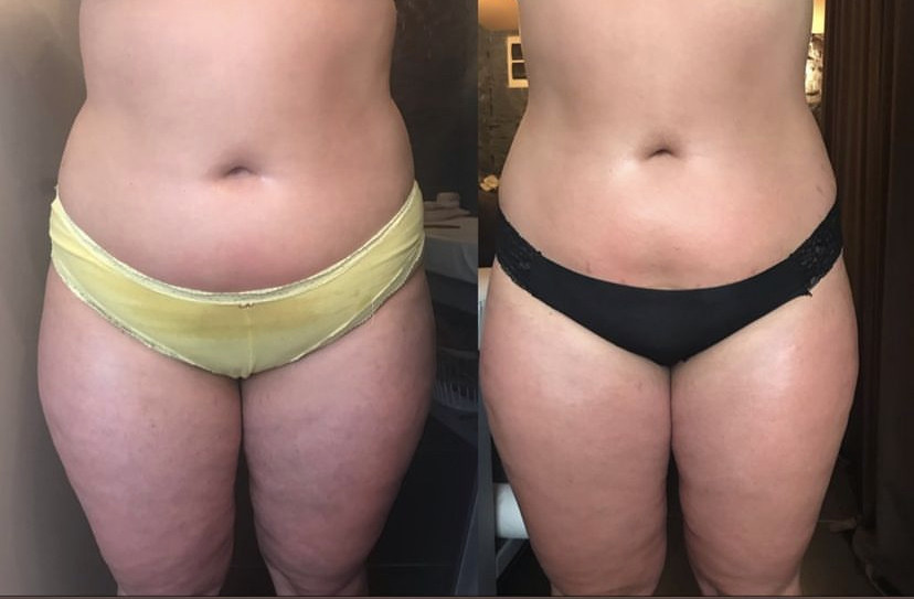 Skockica paket - maderoterapija cijelo tijelo - Fabrika ljepote, Sarajevo Anticelulit masaža Masaža Anticelulit masaža, Sarajevo, Istočno Sarajevo