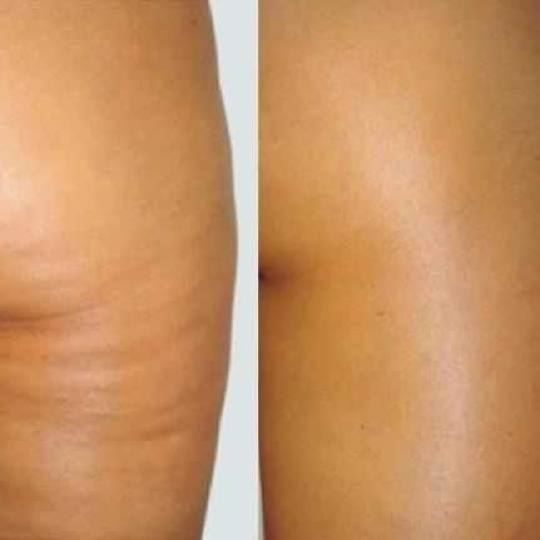 Raindrop #banjaluka Masaža lica Anticelulit masaža + detoks blato - paket od 5 tretmana + 1 gratis