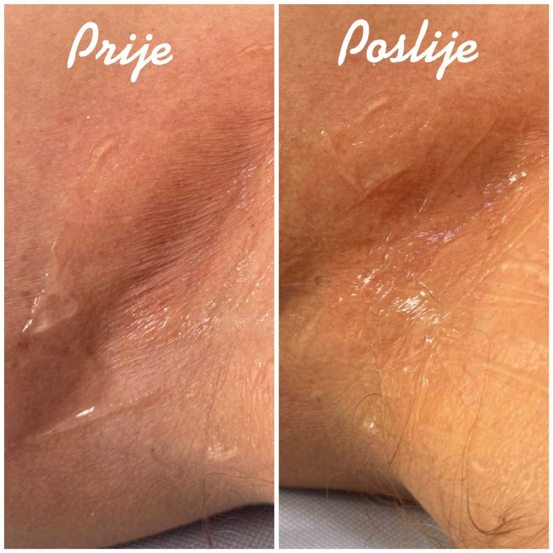 Signature #tuzla Hijaluronski tretmani lica HIFU - cijelo lice