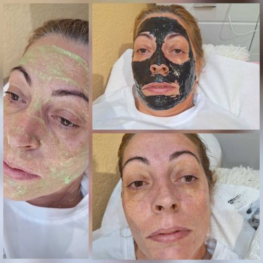 Poezija ljepote #sarajevo Tretman lica Hemijski piling lica - kraljevski tretman
