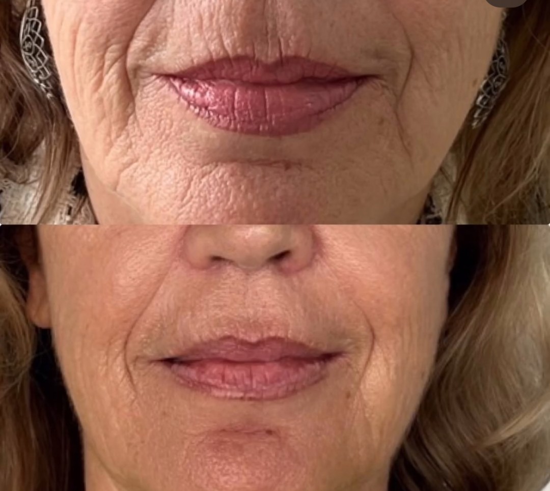 VelaShape #sarajevo Tretman lica RF tretman - lice + vrata