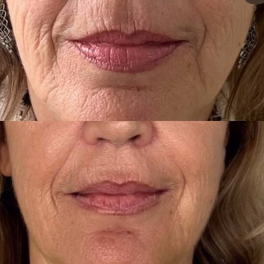 VelaShape #sarajevo Tretman lica RF tretman - lice + vrata Neinvazivno poladjivanje radiofrekvencijo