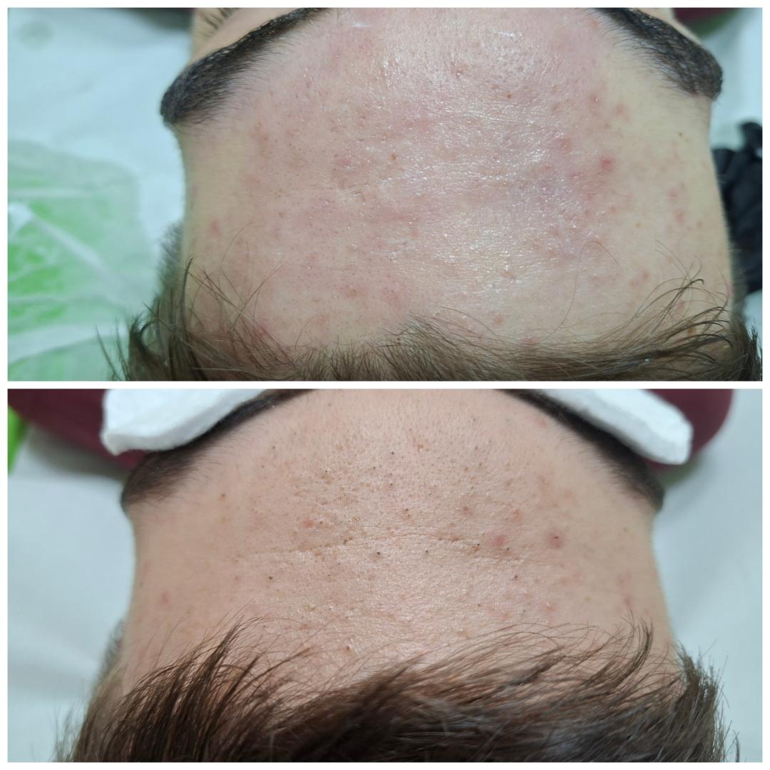 Ultrazvučno čišćenje lica+maska+masaža - La Piel, Mostar Tretman lica Lice Tretman lica, Mostar, Centar