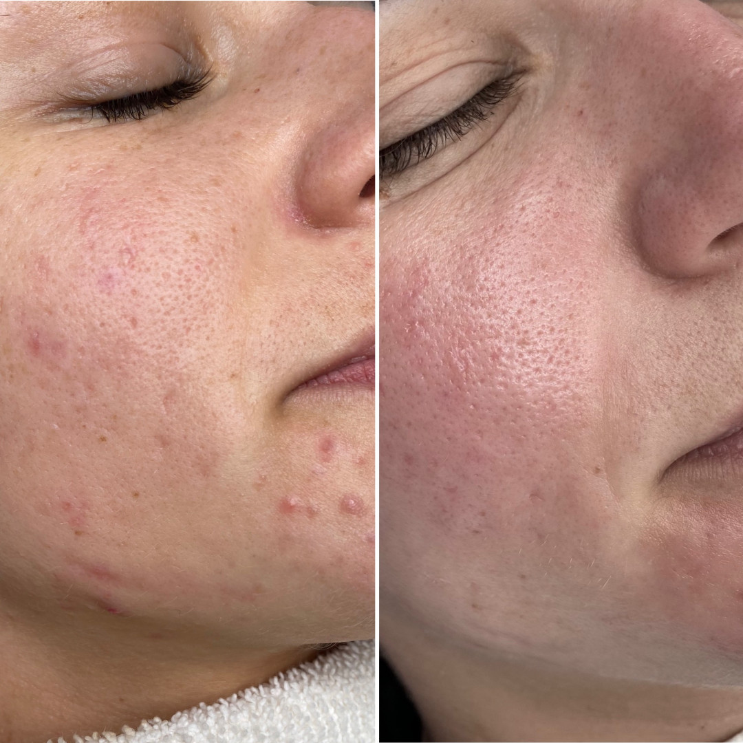 Paket tretmana za masnu kožu - Fabrika ljepote, Sarajevo Tretmani tijela Tijelo Tretmani tijela, Sarajevo, Istočno Sarajevo