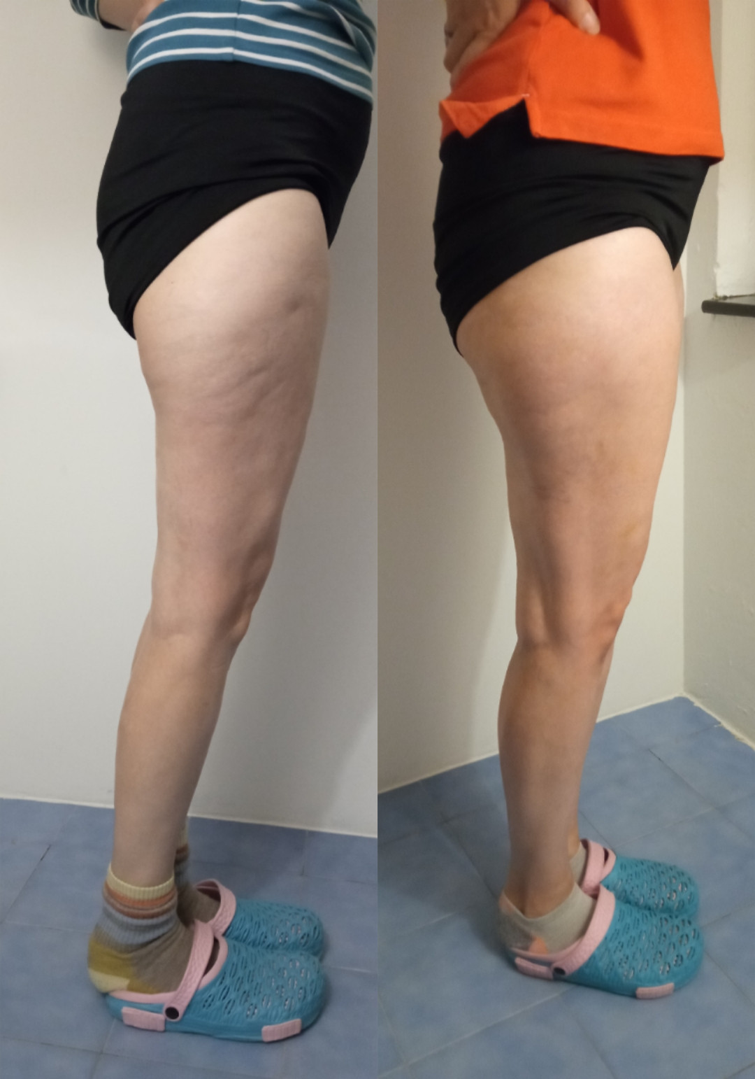 Nervus #banjaluka Anticelulit masaža Anticelulit masaža