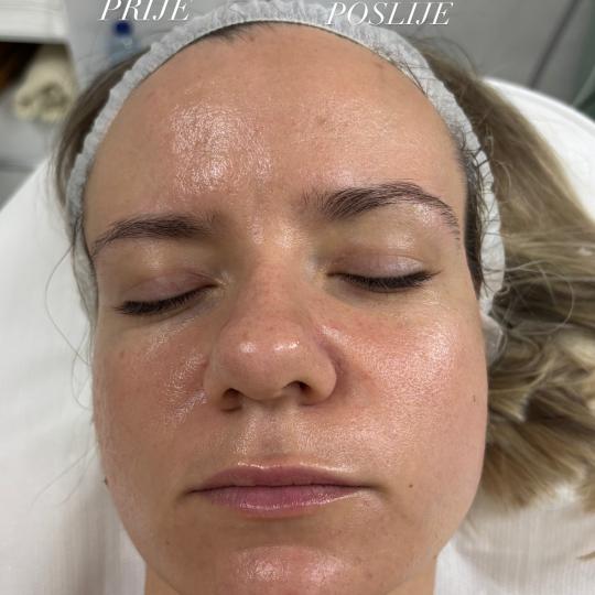 A-Beauty #tuzla Masaža lica Face fitnes Masaza