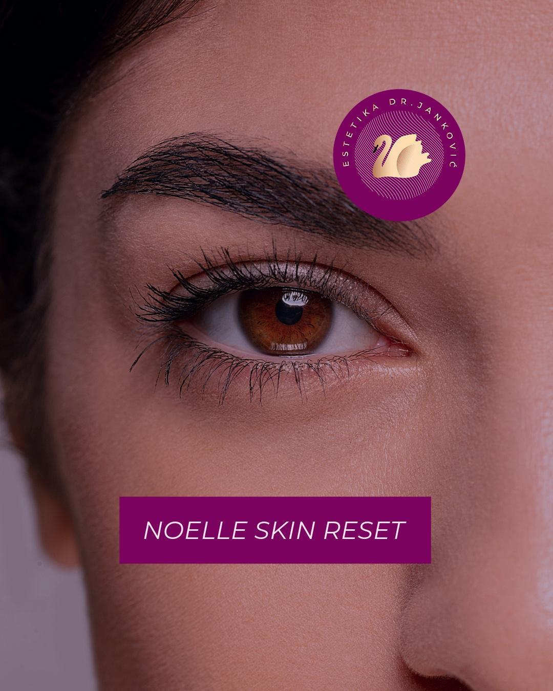 Estetika Janković #banjaluka Tretman lica Noelle skin reset paket - biorevitalizacija lica + biorevitalizacija regije oko očiju