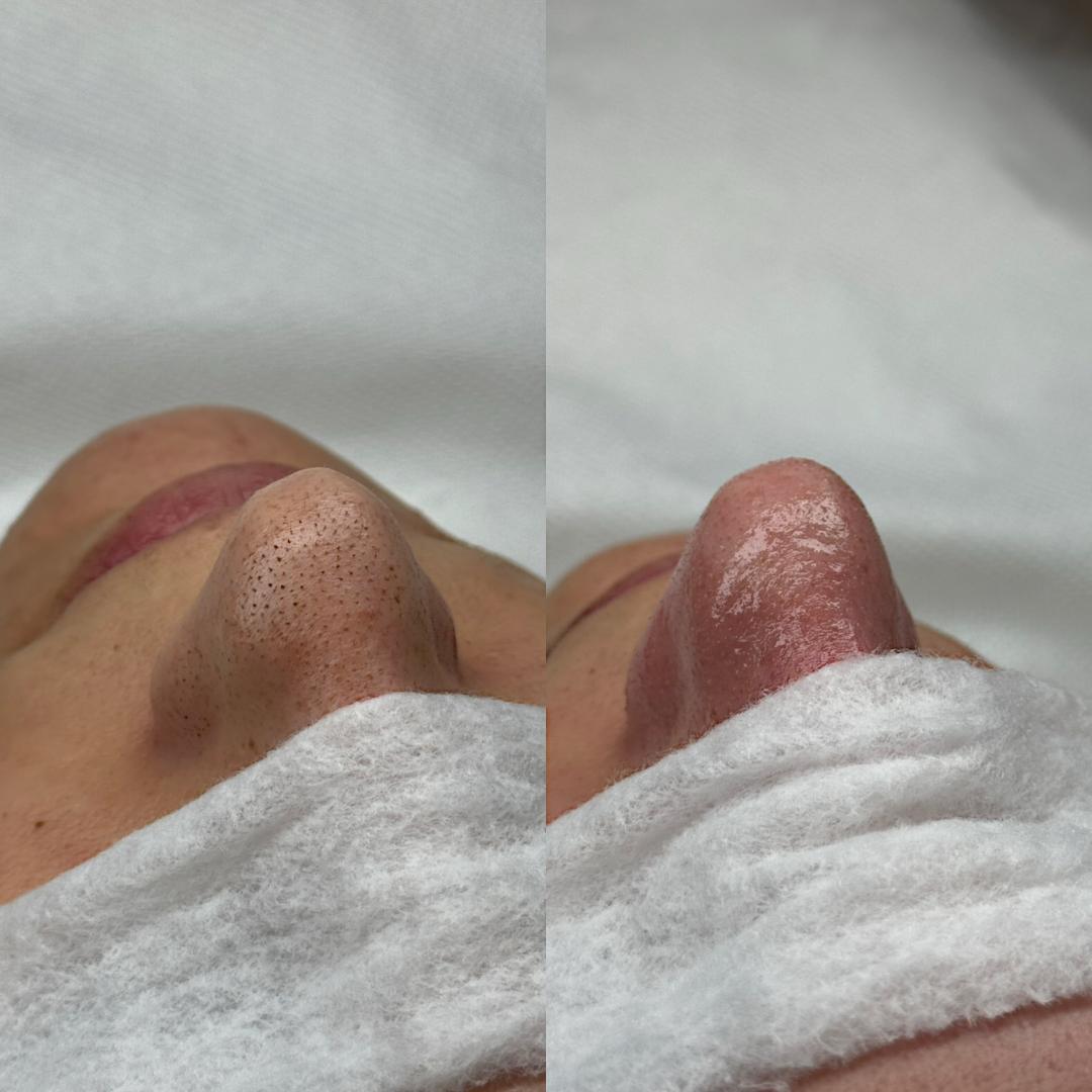 Hanas Skin Centar #banjaluka Air brush potamnjivanje kože Klasično higijensko čišćenje lica