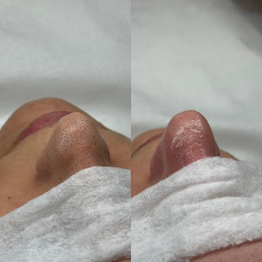 Hanas Skin Centar #banjaluka Air brush potamnjivanje kože Klasično higijensko čišćenje lica Naj