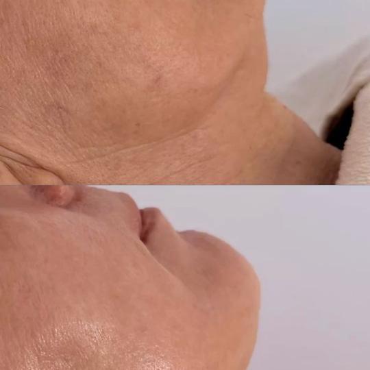Elan beauty by Amra #sarajevo Tretman lica Endosfera lica Poboljšava izgled kože, potiče cirkulac