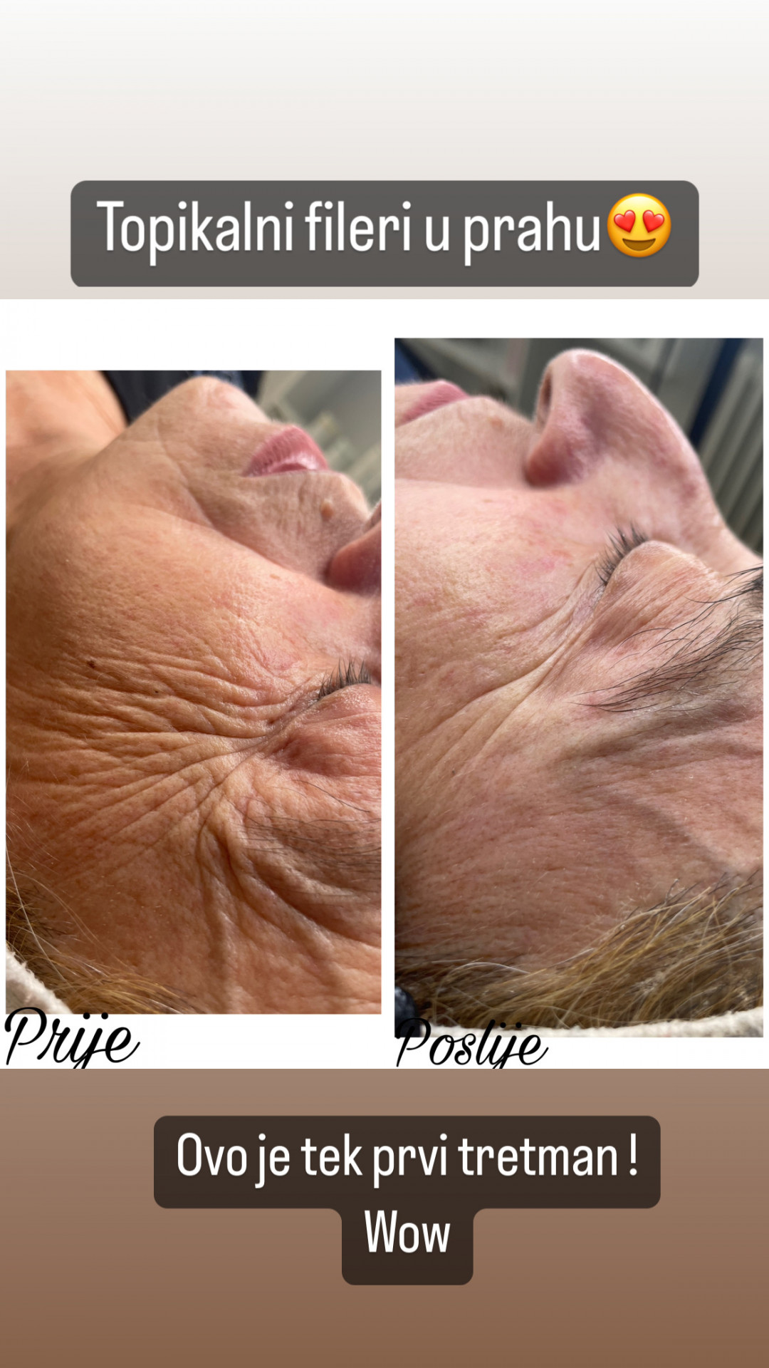 Topikalni filer u prahu - La Esthetique, Sarajevo Mezoterapija lica Lice Mezoterapija lica, Sarajevo, Novo Sarajevo - Novi Grad