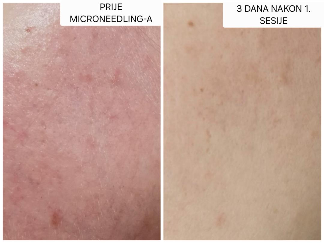 Sakina #sarajevo Mezoterapija lica Microneedling Face
