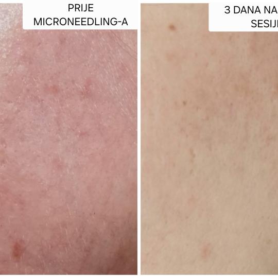Sakina #sarajevo Mezoterapija lica Microneedling Face