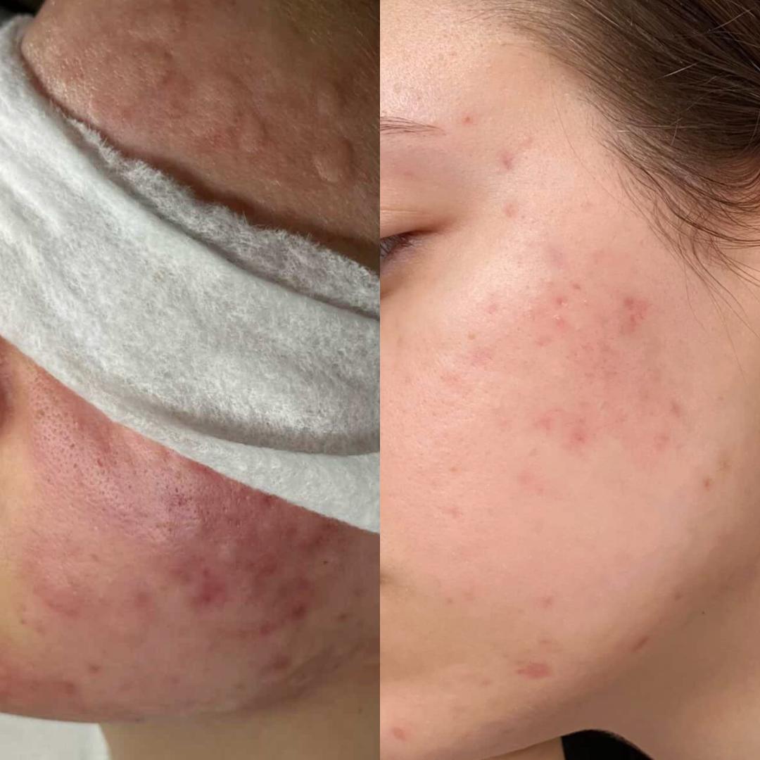 Hemijski piling - akne - Hanas Skin Centar, Banja Luka Tretman lica Lice Tretman lica, Banja Luka, Centar