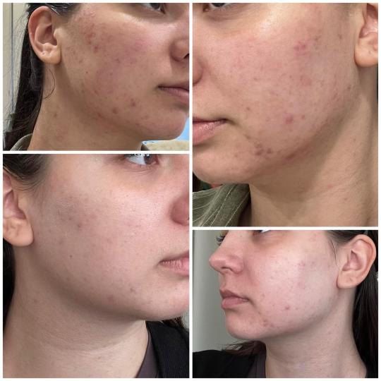 Gaia beauty & beyond #banjaluka Mezoterapija lica BDR mezoterapija Clear and fresh ✨ BDR CLEAR & F
