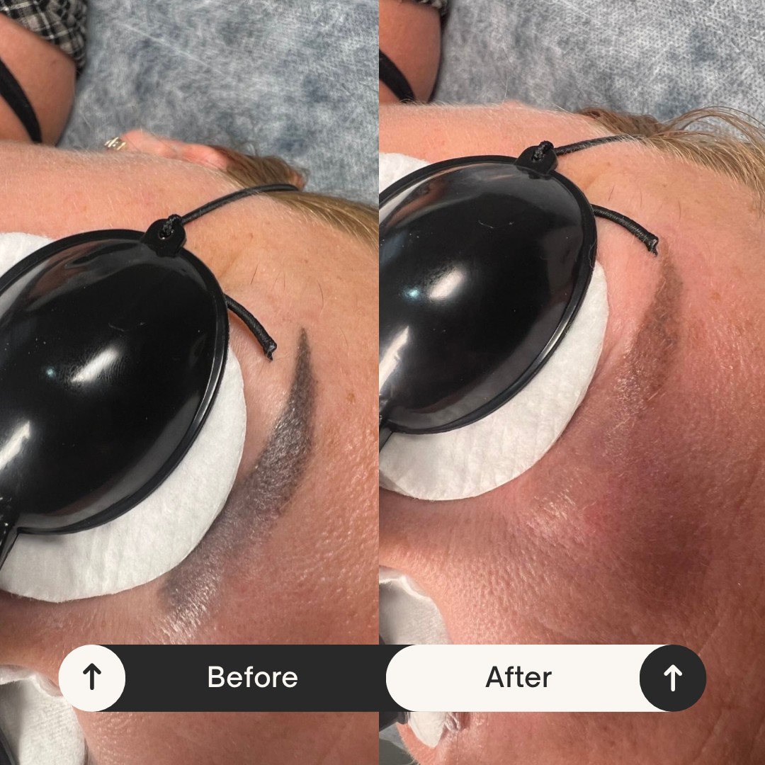 AEsthetic Bar Academy #sarajevo Make-up / šminkanje Lasersko uklanjanje permanent šminke / tetovaže