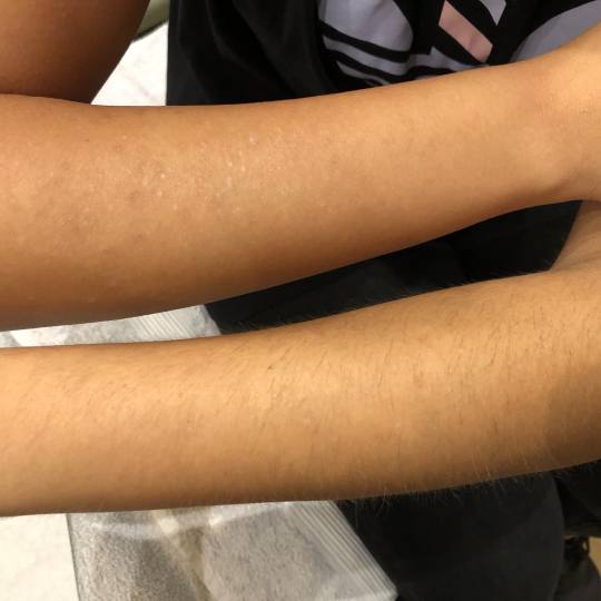 La Crème Beauty Studio #sarajevo Depilacija voskom Depilacija pola ruku hladnim voskom - za dame