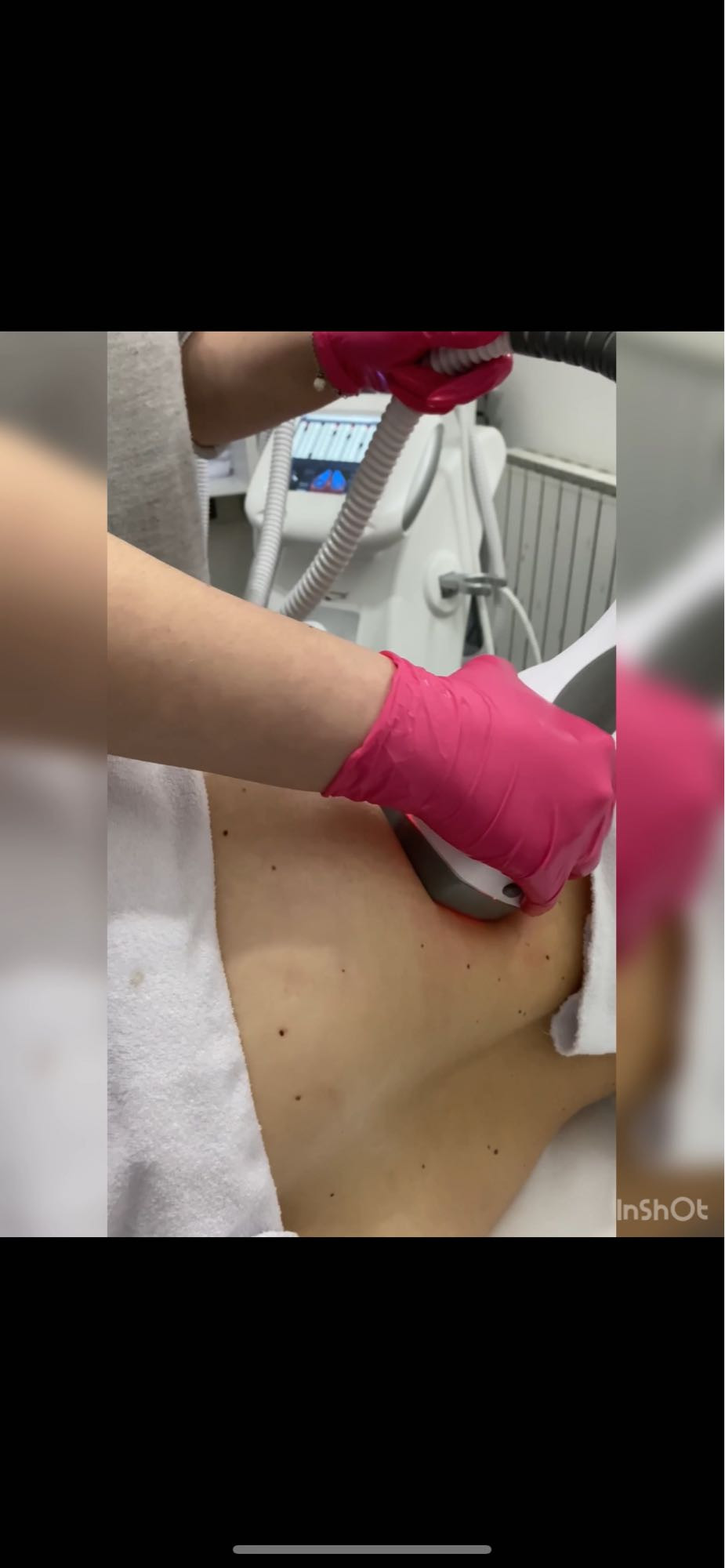 Laser Beauty Studio #visoko Tretman lica Zatezanje kože i redukcija masnih naslaga - stomak