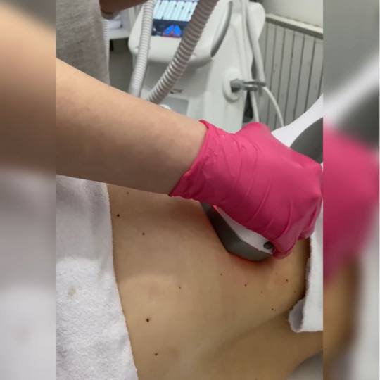 Laser Beauty Studio #visoko Tretman lica Zatezanje kože i redukcija masnih naslaga - stomak