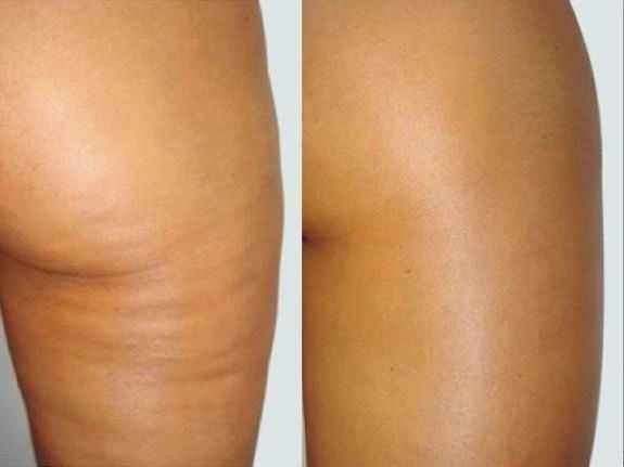 Raindrop #banjaluka Anticelulit masaža Limfna drenaža + modeliranje tijela - 60 minuta