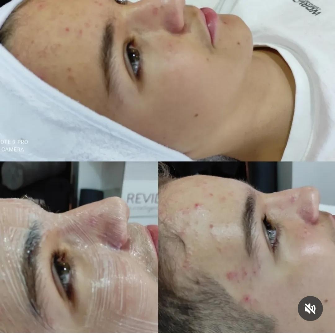 Reviderm acid peel tretman lica + vrata - Delta M, Brčko Tretman lica Lice Tretman lica, Brčko, Centar