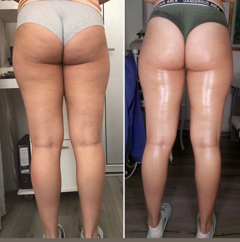 Skockica paket - maderoterapija noge + gluteus - Fabrika ljepote, Sarajevo Anticelulit masaža Masaža Anticelulit masaža, Sarajevo, Istočno Sarajevo