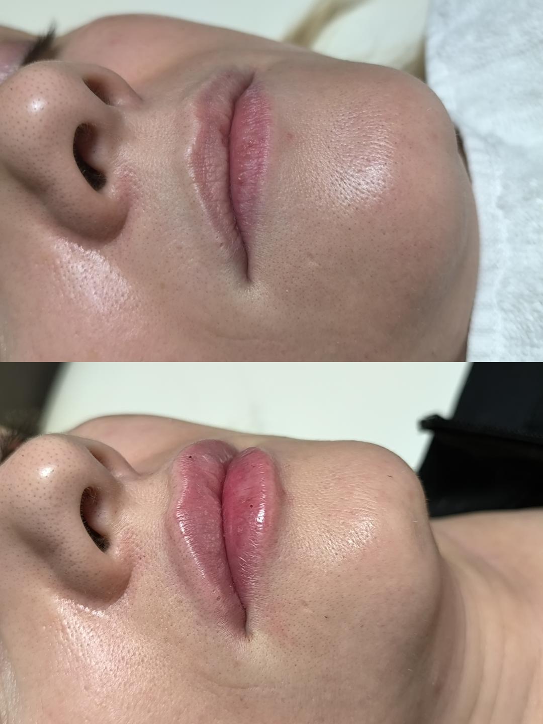 Estetika Janković #banjaluka Tretman lica Hijaluronski filer - 1 ml