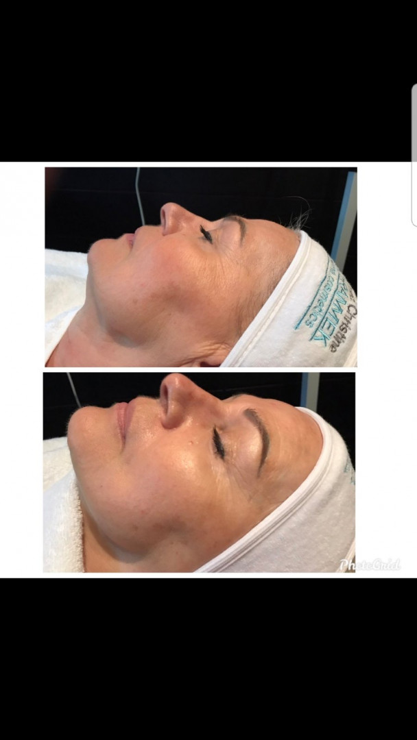 Vedrana #sarajevo Tretman lica