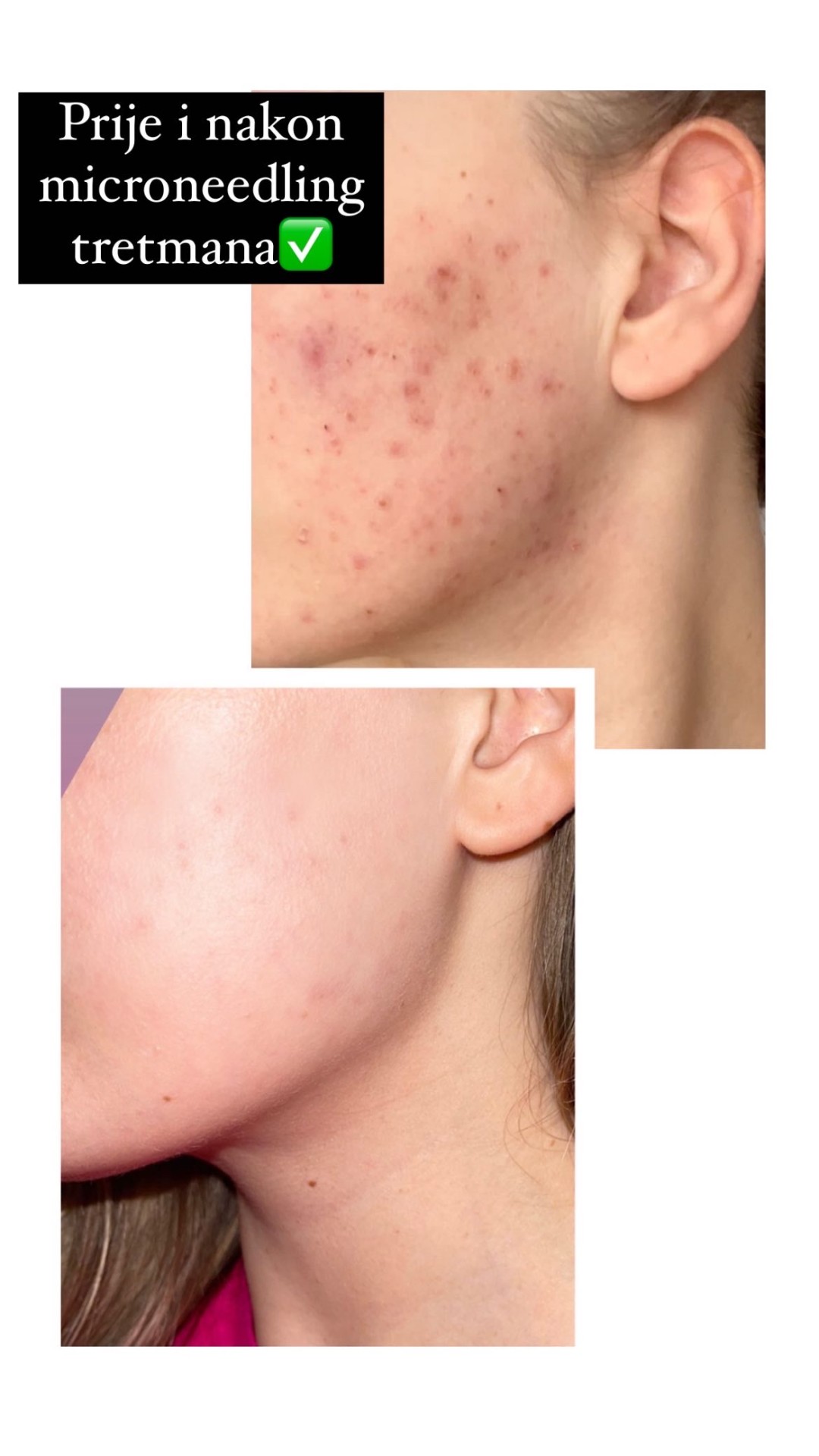 Damen #sarajevo Tretman lica Ultrazvučno čišćenje + microneedling tretman lica