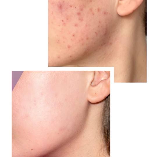 Damen #sarajevo Tretman lica Ultrazvučno čišćenje + microneedling tretman lica Liječenje proble