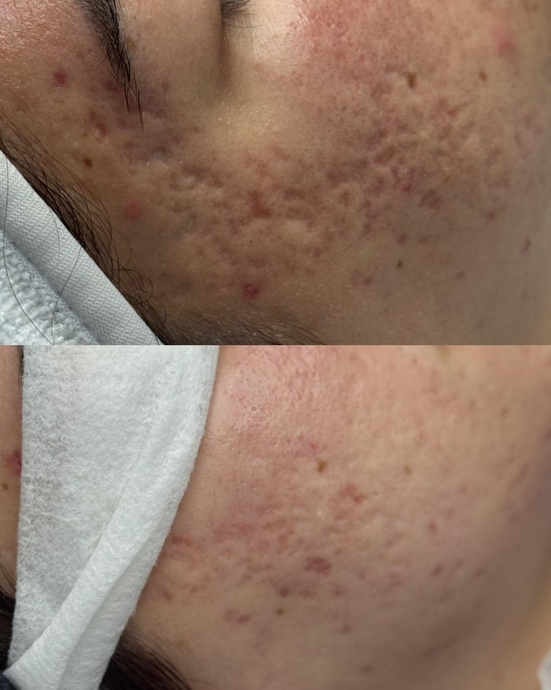 Microneedling tretman protiv ožiljaka od akni - Hanas Skin Centar, Banja Luka Tretman lica Lice Tretman lica, Banja Luka, Centar